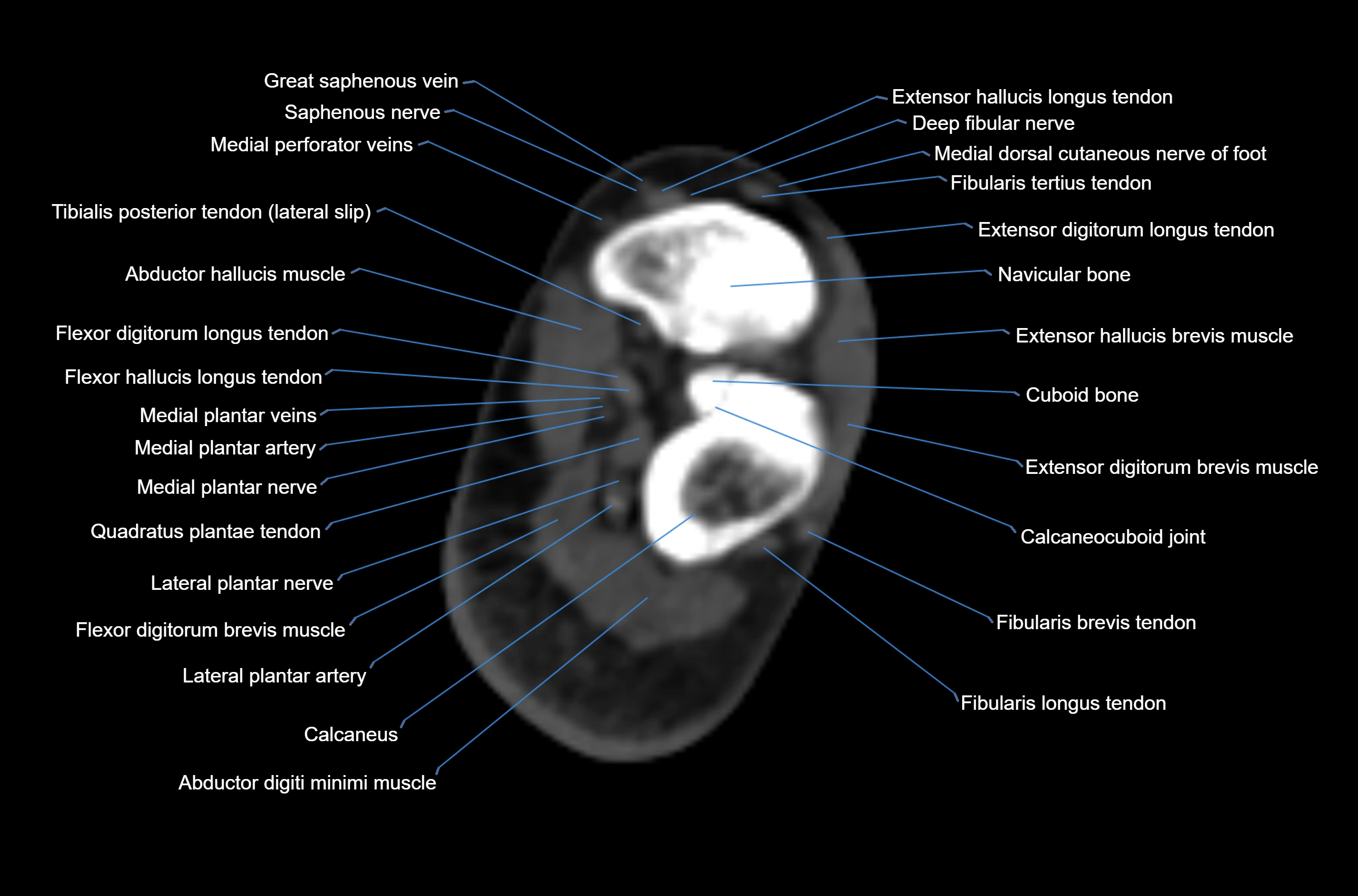 CT Ankle axial cross sectional anatomy labelled image -00045.webp